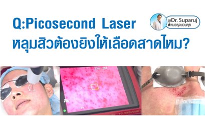 Q:Picosecond Laser หลุมสิวต้องยิงให้เลือดสาดไหม?